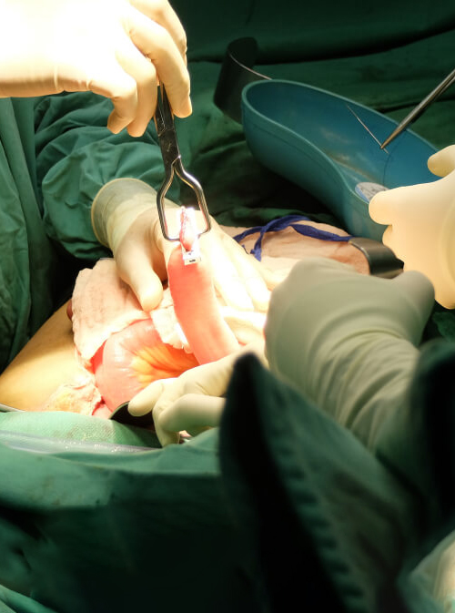 colectomy as a type of colorectal surgery